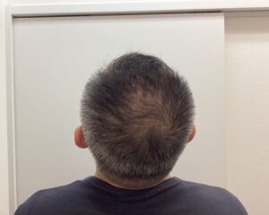 AGA治療前　49歳男性　生え際・頭頂部薄毛　新潟院