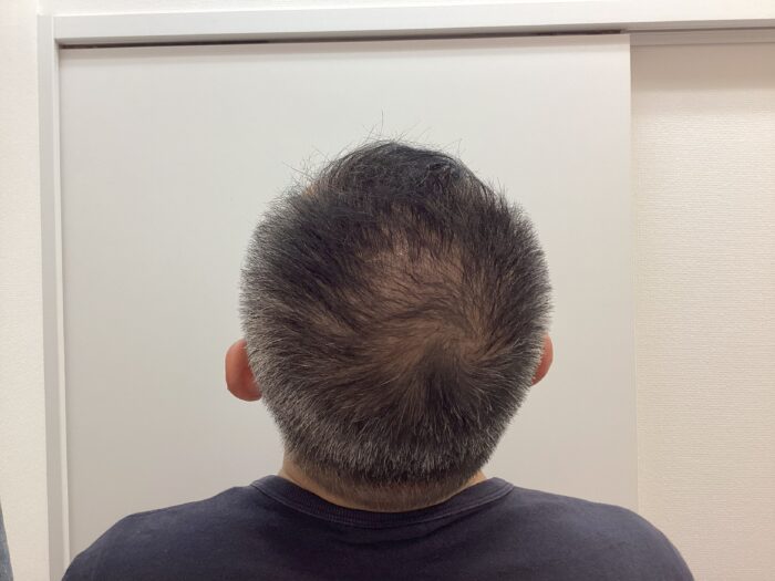 【49歳男性】生え際・頭頂部の薄毛がAGA治療で改善中｜新潟院