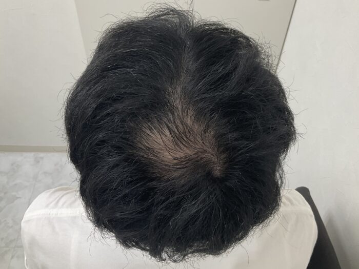 【40歳男性】頭頂部の薄毛がAGA治療で改善｜岡山院