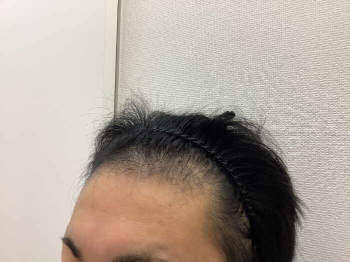 【30歳男性】前頭・頭頂部の薄毛がAGA治療で改善｜新潟院