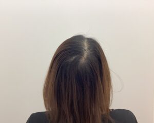FAGA9ヶ月後　40歳女性　生え際・頭頂部改善中　新潟院