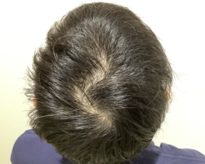 AGA治療前＿30歳男性＿頭頂部の薄毛＿姫路院