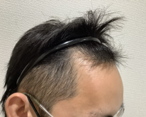 AGA治療前＿30歳男性＿生え際の薄毛＿姫路院