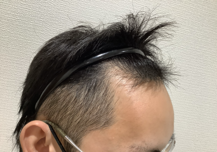 【30歳男性】生え際の薄毛がAGA治療で改善｜姫路院