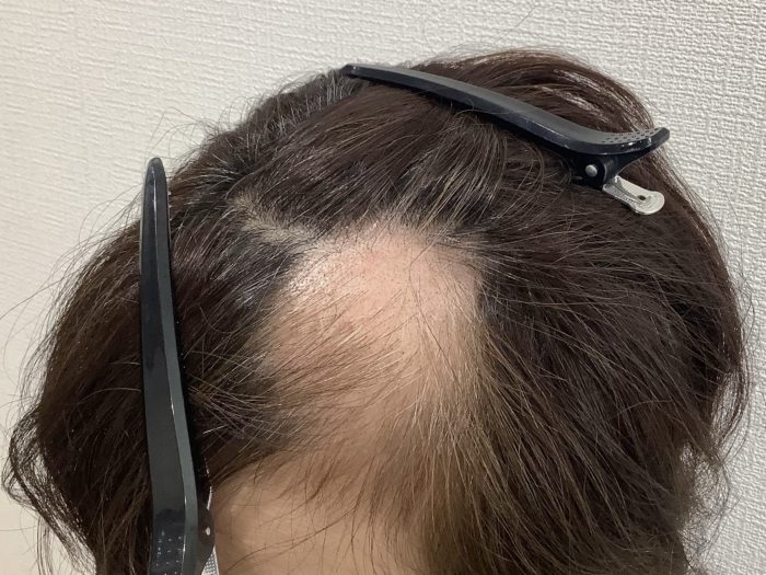 【55歳女性】多発型円形脱毛症が改善｜姫路院