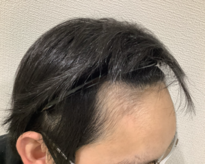 AGA治療後＿30歳男性＿生え際の薄毛が改善＿姫路院