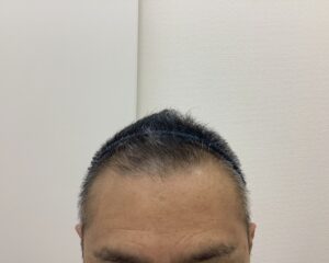 AGA治療10ヶ月後　49歳男性　生え際・頭頂部改善中　新潟院