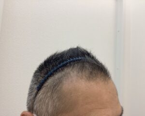 AGA治療10ヶ月後　49歳男性　生え際・頭頂部改善中　新潟院
