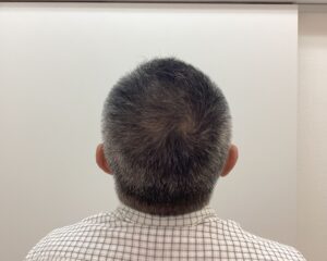 AGA治療10ヶ月後　49歳男性　生え際・頭頂部改善中　新潟院