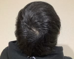 AGA治療後＿30歳男性＿頭頂部の薄毛が改善＿姫路院