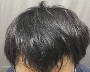 AGA治療5ヶ月後　26歳男性　前頭部改善　京都院