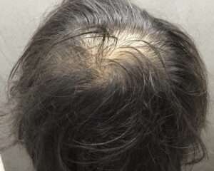 AGA治療前　26歳男性　頭頂部薄毛　京都院