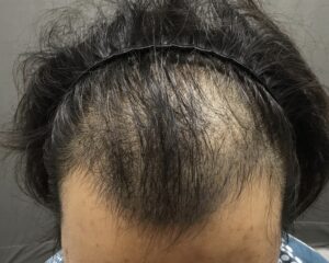 AGA治療2ヶ月後　26歳男性　前頭部改善　京都院