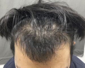 AGA治療5ヶ月後　26歳男性　前頭部改善　京都院