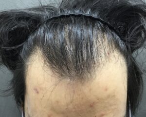 AGA治療前　26歳男性　前頭部薄毛　京都院
