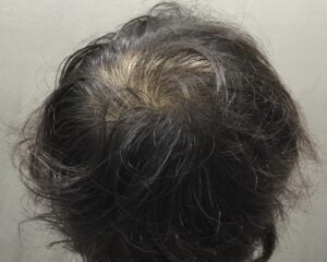 AGA治療2ヶ月後　26歳男性　頭頂部改善　京都院