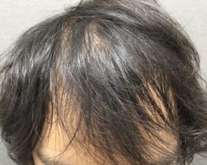 AGA治療前　26歳男性　前頭部薄毛　京都院