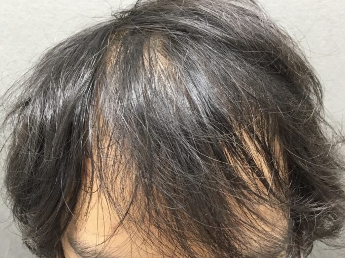 【26歳男性】生え際・頭頂部の薄毛がAGA治療で改善｜京都院