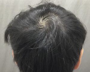 AGA治療5ヶ月後　26歳男性　頭頂部改善　京都院