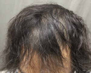 AGA治療2ヶ月後　26歳男性　前頭部改善　京都院