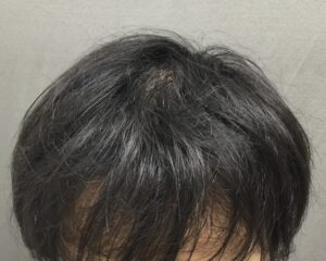 AGA治療8ヶ月後　19歳男性　前頭部改善　京都院