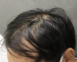 AGA治療前　19歳男性　前頭部薄毛　京都院