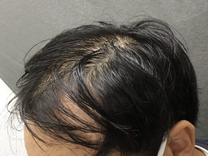 【19歳男性】生え際・頭頂部の薄毛がAGA治療で改善｜京都院