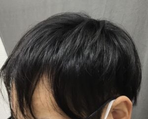 AGA治療4ヶ月後　19歳男性　前頭部改善　京都院