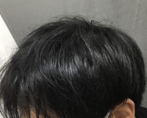 AGA治療8ヶ月後　19歳男性　前頭部改善　京都院