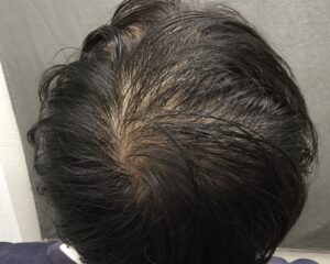 AGA治療前　19歳男性　頭頂部薄毛　京都院