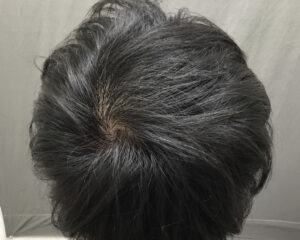 AGA治療4ヶ月後　19歳男性　頭頂部改善　京都院