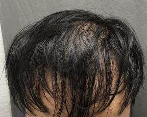 AGA治療前　19歳男性　前頭部薄毛　京都院