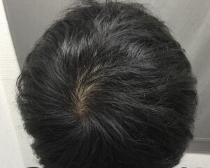 AGA治療8ヶ月後　19歳男性　頭頂部改善　京都院