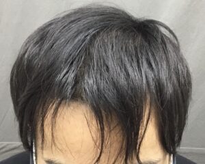 AGA治療4ヶ月後　19歳男性　前頭部改善　京都院