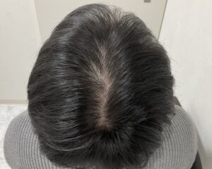  AGA治療前　38歳男性　生え際・頭頂部薄毛　岡山院