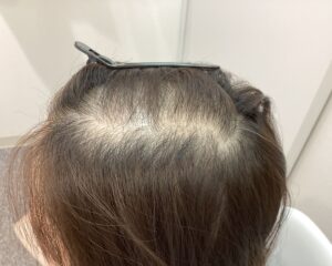 FAGA治療前　40歳女性　生え際・頭頂部薄毛　新潟院