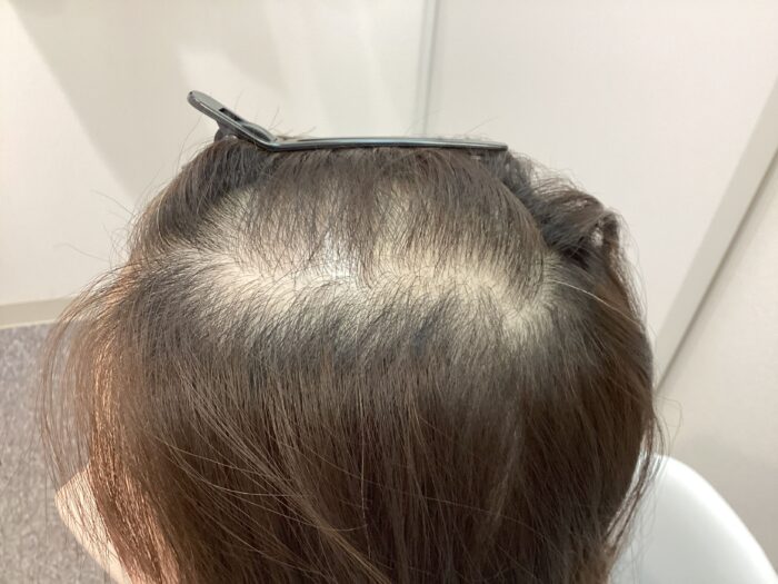 【40歳女性】生え際・頭頂部の薄毛がFAGA治療で改善中｜新潟院