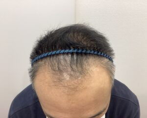 AGA治療前　49歳男性　生え際・頭頂部薄毛　新潟院