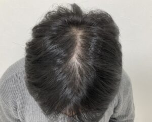 AGA治療前　38歳男性　生え際・頭頂部薄毛　岡山院
