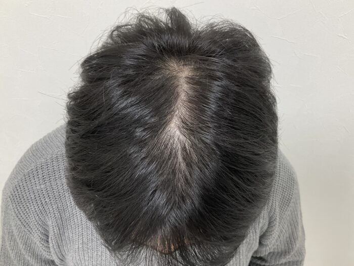 【38歳男性】生え際・頭頂部の薄毛がAGA治療で改善｜岡山院