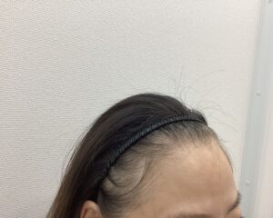 FAGA治療前　49歳女性　生え際・分け目薄毛　新潟院