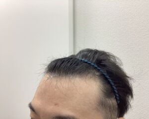 AGA治療前　36歳男性　前頭・頭頂部薄毛　新潟院