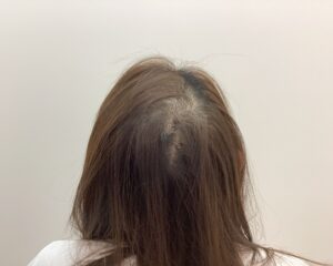 FAGA治療前　40歳女性　生え際・頭頂部薄毛　新潟院