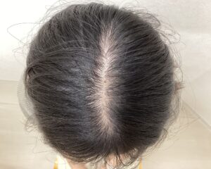FAGA治療2ヵ月目　20歳女性　分け目薄毛　横浜院