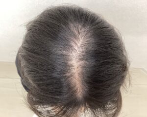 FAGA治療前　20歳女性　分け目薄毛　横浜院
