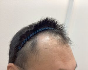 AGA治療前　47歳男性　生え際・頭頂部薄毛　新潟院