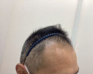 AGA治療前　49歳男性　生え際・頭頂部薄毛　新潟院