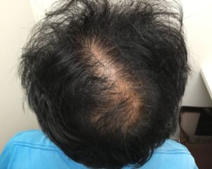 AGA治療前＿56歳男性＿生え際と頭頂部の薄毛＿大阪梅田院