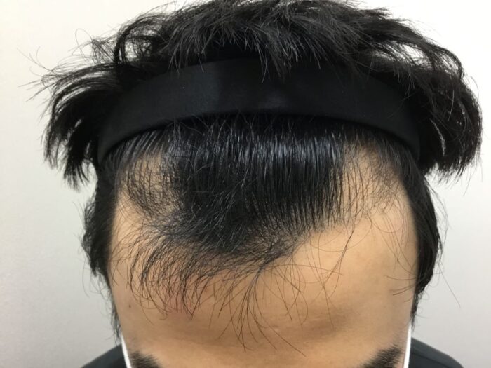 【33歳男性】生え際の薄毛がAGA治療で改善｜大阪梅田院