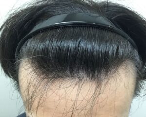 AGA治療前_41歳男性＿生え際と頭頂部の薄毛＿大阪梅田院